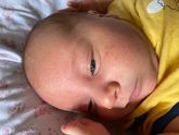 Сыпь на лице и шее 1 месяц
