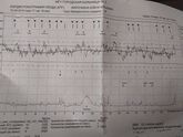 35-36 нед. КТГ 8 БАЛЛОВ:( Децелерации (3)