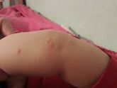 Непонятные прыщи после сна.