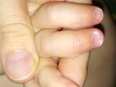 Уродские ногти