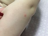 Прыщи на руках у ребёнка 8 мес