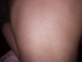 При каких заболеваниях сыпь оставляет пигментацию?