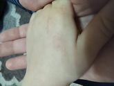 Высыпания на руке