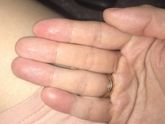 Трещины на пальцах
