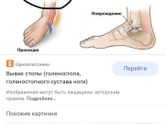 Вывихнула ногу