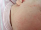 Аллергия или акне новорожденного?