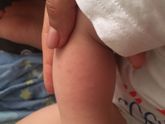 Покраснение на руке . Что может быть