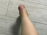 Отеки