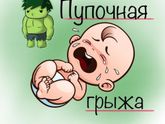 Пупочная грыжа