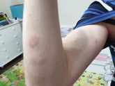 Пятна на теле у