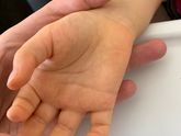 Желтушка после года