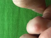 Болячки на пальчиках