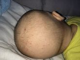 Красные пятна на голове
