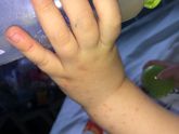Новая сыпь на ручках