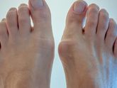 Операция при HAIIUX Valgus!!!