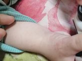 Аллергия на нурофен