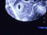 Плодное яйцо 19 мм, эмбриона не видно. 5 недель и 6 дней