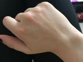 Краснота и зуд на руках
