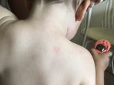 Стали появляться красные пятна на лице, спине и груди