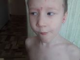 После ветрянки.