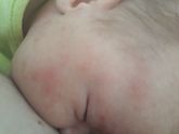 Аллергия?