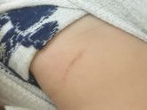 Коричневые пятнышки на теле малыша