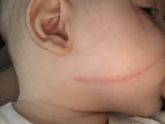 Чем помазать царапину на лице ребёнку