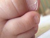 Грибок на ногтях или витаминов не хватает?