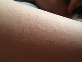 У меня гусиная кожа