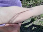 Аллергия или потница на