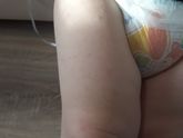 Аллергия???