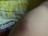 Прививка. Кто сталкивался ?