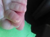 Кто сталкивался с проблемой вросшего/сорванного ногтя у малышей? (с фото)
