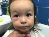 Укус комара
