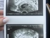 Моя любовь! ❤️ узи, 8.3 недели