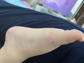 Подскажите пожалуйста есть ли плоскостопие ?