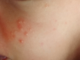 Аллергия?