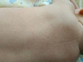 Потничка или аллергия??