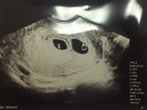 Узи 6 недель 2 плодных яйца