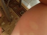 Отеки.