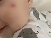 Был маленький прыщик, который