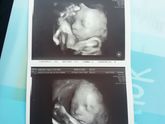 3 скрининг🌼 31 неделька🤰
