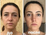 Омоложение лица Девочки