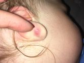 Шишка после прокалывания ушек