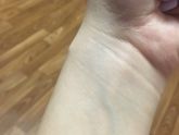 Кость выходит ?
