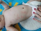 Реакция после прививки гексаксим