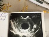 Анэмбриония плодное яйцо без эмбриона