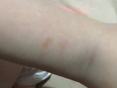 Сухие корочки на коже