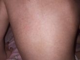 При каких заболеваниях сыпь оставляет пигментацию?