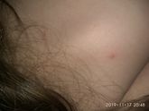 Прыщик?